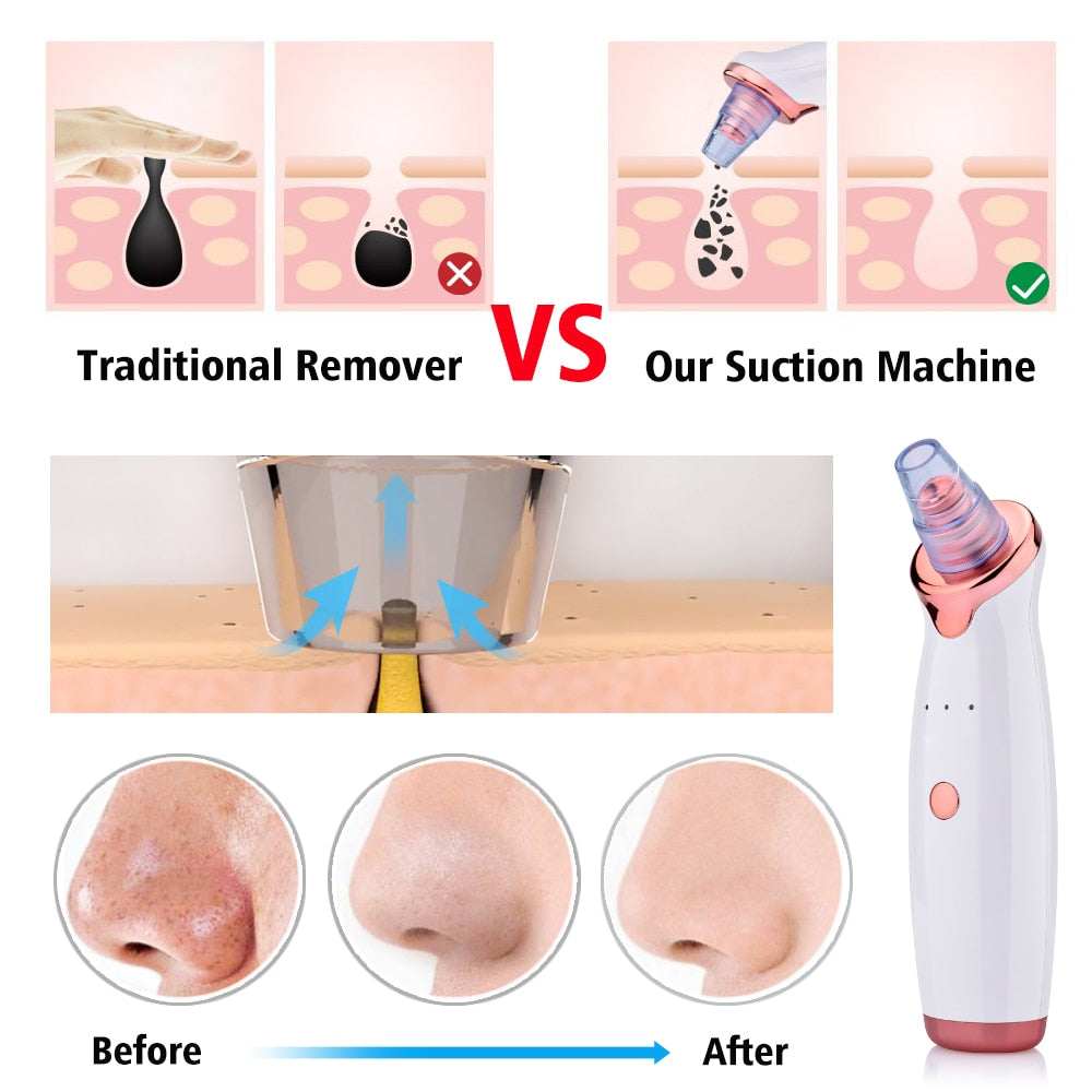 Appareil Anti-Points Noirs Électrique — Aspiration & Nettoyage Visage | Blackhead Remover